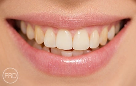 laser teeth whitening