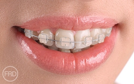 straighter teeth without braces