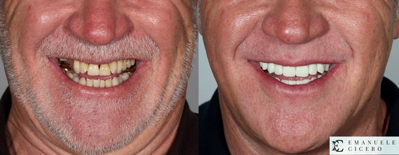 Full Mouth Reconstruction