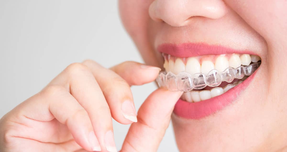 Retainers - Direct Dental Wandsworth