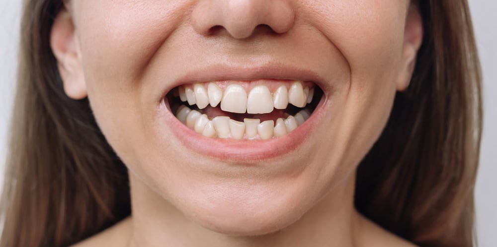 Long-Term Stability: How Long Does It Take to Straighten Teeth? - Direct Dental Wandsworth