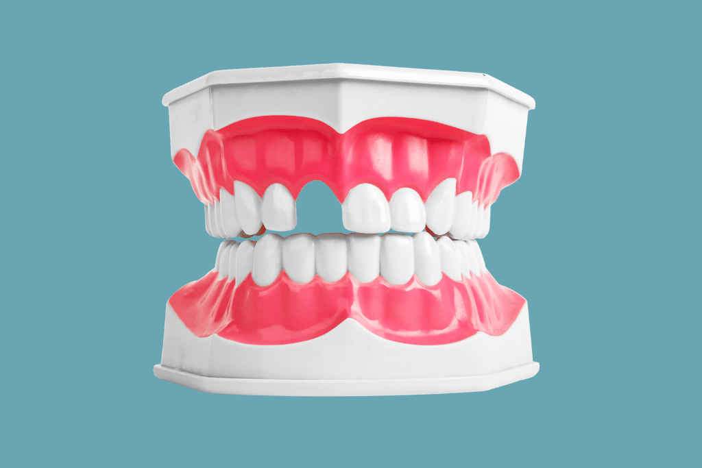 Gaps in Teeth - Fulham Road Dental