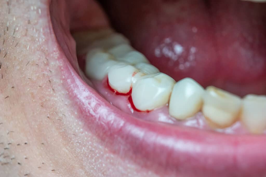 Gum disease Warning signs and symptoms Gum disease Warning signs and symptoms