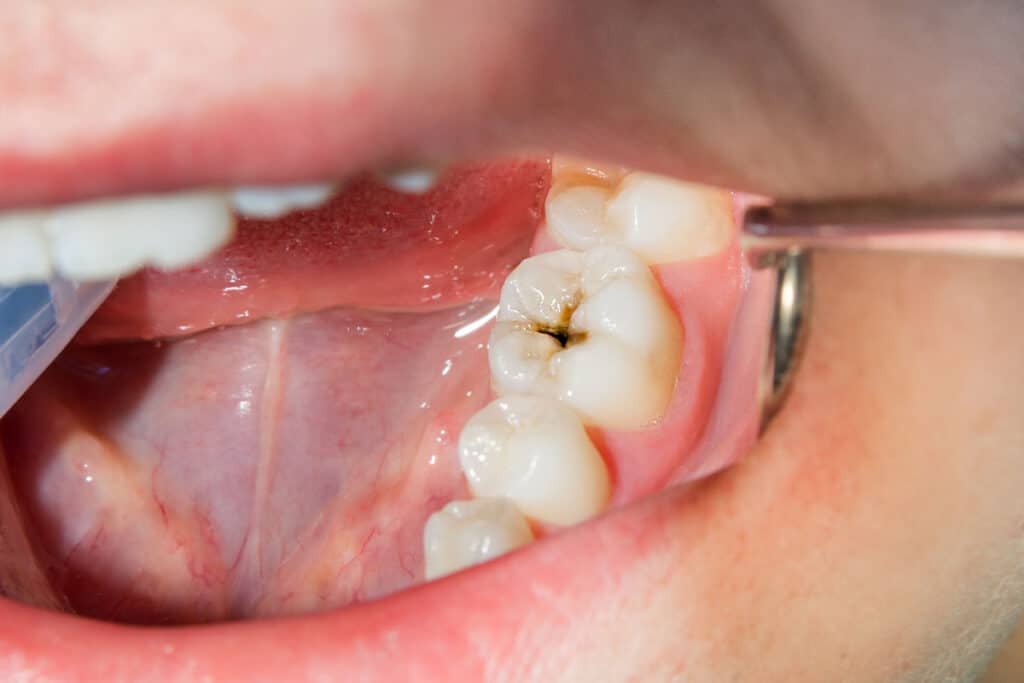 How cavities develop How cavities develop