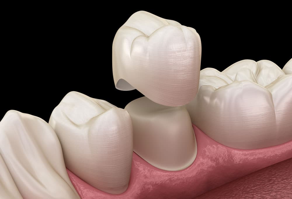 Restoring tooth functionality Restoring tooth functionality