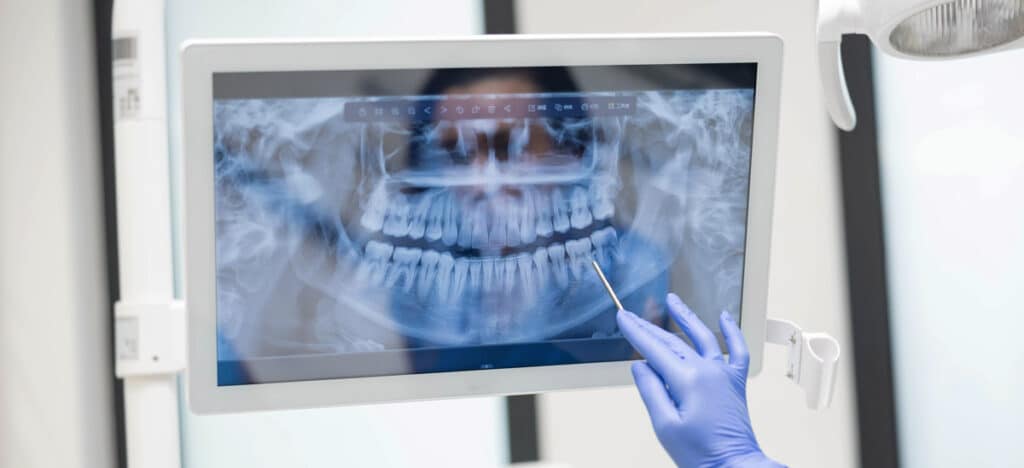 Tooth decay treatment Tooth decay treatment