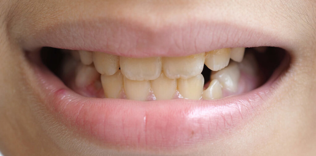 Understanding plaque and tartar Understanding plaque and tartar