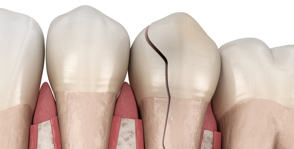 What causes cracks in teeth What causes cracks in teeth