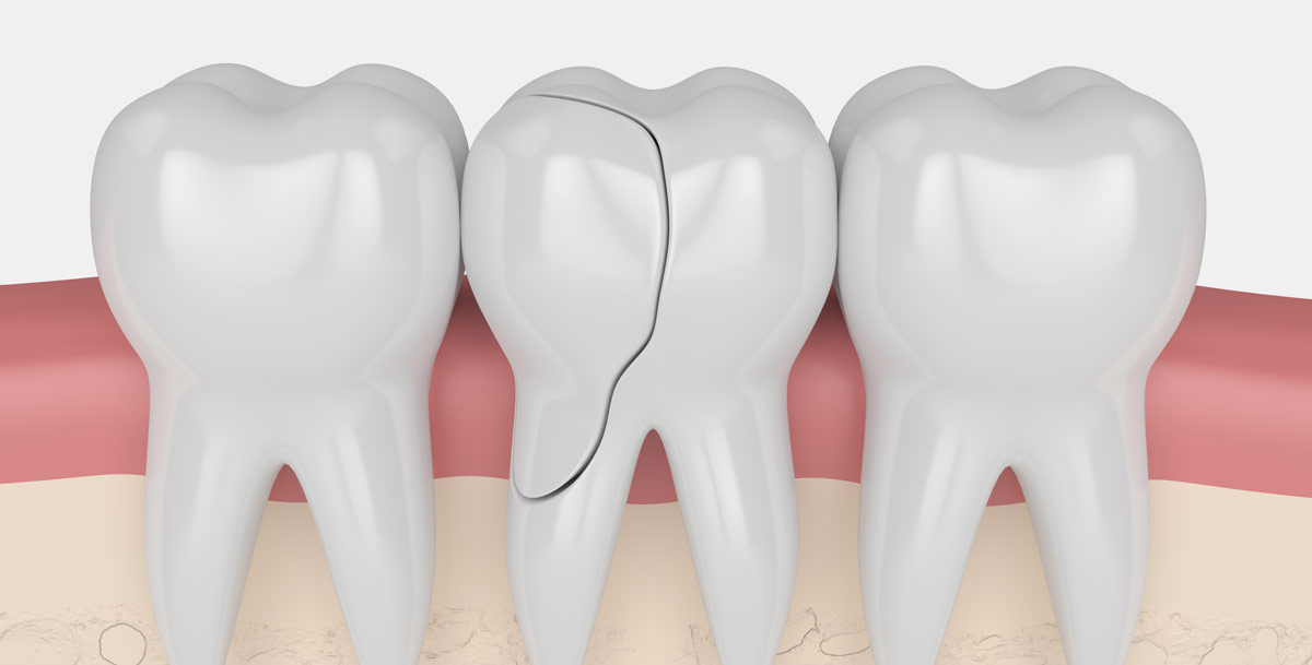 Common causes of broken teeth Common causes of broken teeth
