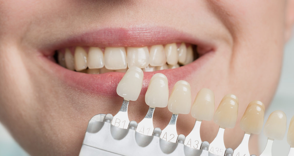 Treatment options for broken teeth Treatment options for broken teeth