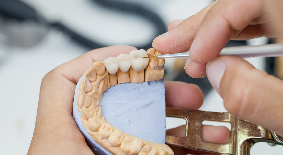 Types of dental bridges Types of dental bridges