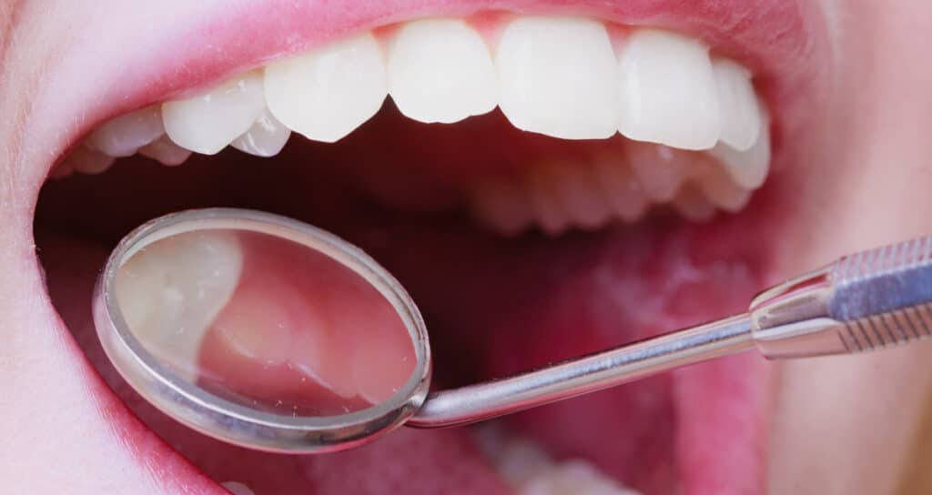 Diagnosing a cavity in the front tooth